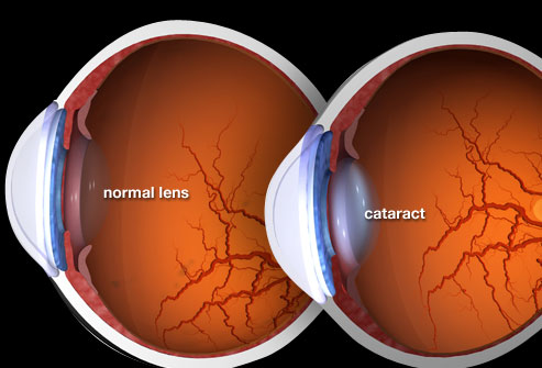 photo of cataract illustration